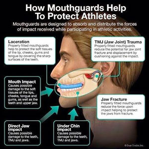 Athletic-Mouth-Guard-birmingham-al