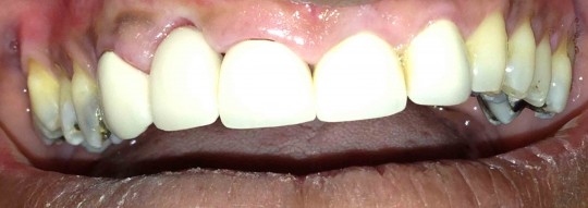 dental-bridge-after1-birmingham-al.