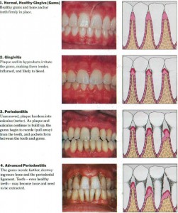 stages_of_perio_disease