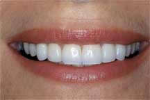 Chipped Tooth After Veneer
