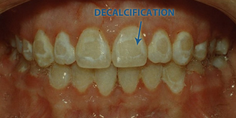 decalcification-due-to-braces