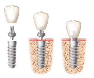 Dental_Implant_abutment_crown-birmingham-al