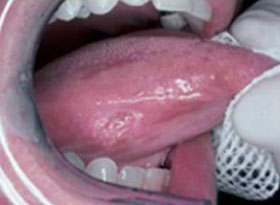 Birmingham Oral Cancer Screening Dentist
