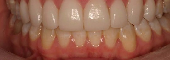 Porcelain-veneers-after-birmingham-al