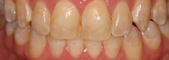 Porcelain-veneers-before-birmingham-al