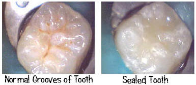 dental-Sealant_birmingham-al-Before-After