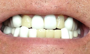 dental-crown-birmingham-al-before