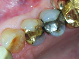 dental-crown1-birmingham-al