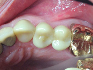 dental-crown2-birmingham-al