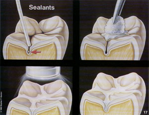 dental-sealants2-birmingham-al
