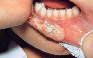 dental-self-inflicted-injury1-birmingham-al