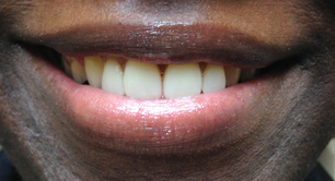 partial-denture-after2-birmingham-al