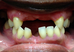 partial-denture-before-birmingham-al