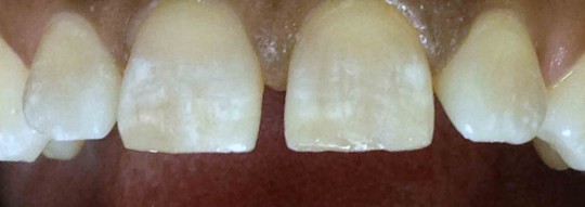 tooth-bonding-birmingham-al-after