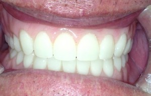 birmingham-al-denture-best-value-price