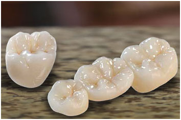 Birmingham best metal dental crowns - Comfort Plus Family Dental (205) 833-5405 - affordable dental crowns in Birmingham, AL