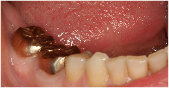 Birmingham best gold dental crowns - Comfort Plus Family Dental (205) 833-5405 - affordable dental crowns in Birmingham, AL