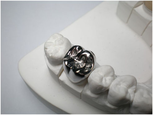 Birmingham best metal dental crowns - Comfort Plus Family Dental (205) 833-5405 - affordable dental crowns in Birmingham, AL