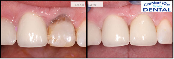 Birmingham best dental crowns - Comfort Plus Family Dental (205) 833-5405 - affordable dental crowns in Birmingham, AL